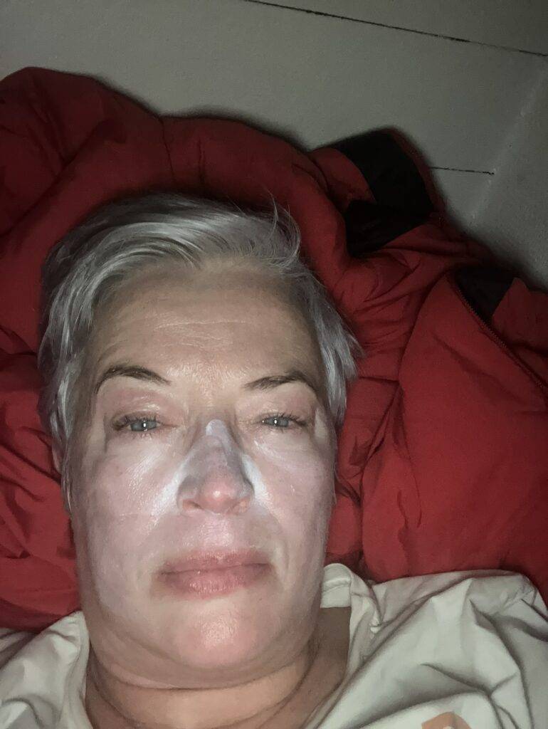 woman with a windburnt face this happens after off-piste skiing in the cold and wind when on expedition
